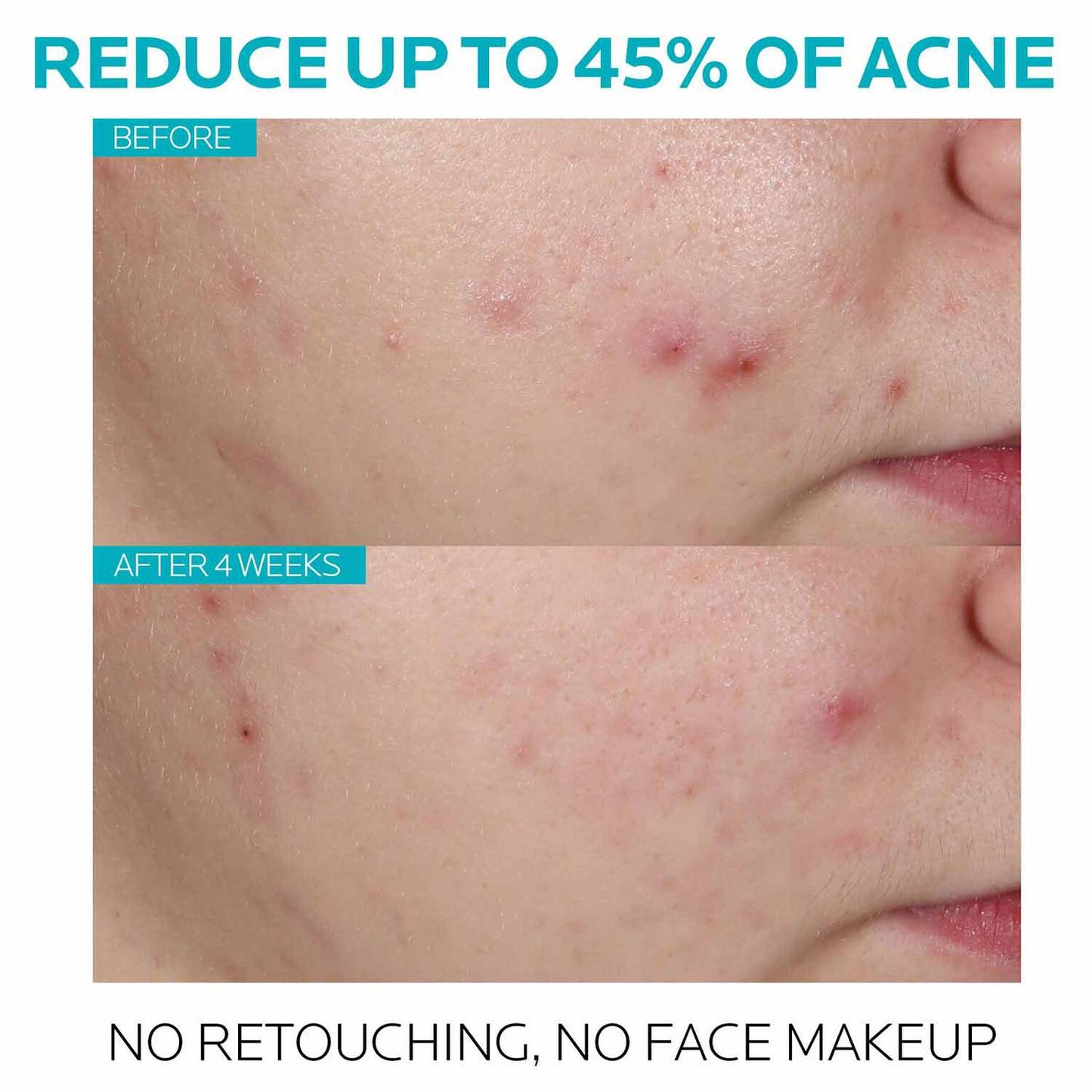 effaclar-salicylic-acid-acne-treatment-serum-r0 7_EffaclarSerum_After-45-days.jpg
