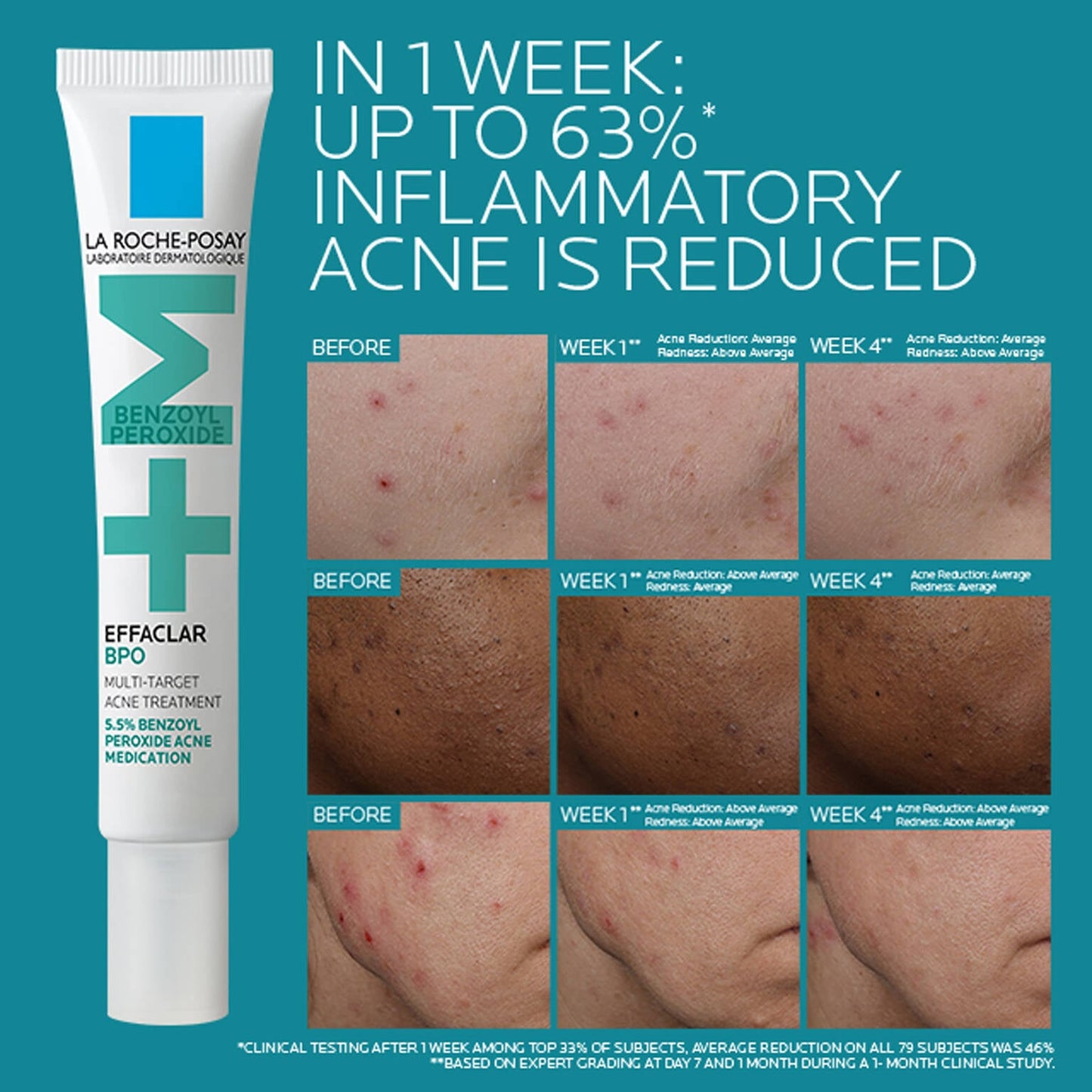 effaclar-bpo-multi-target-acne-treatment-with-5-5-benzoyl-peroxide-a5 EffaclarBPO-ClinicalBA-ATF-1500x1500-2.jpg