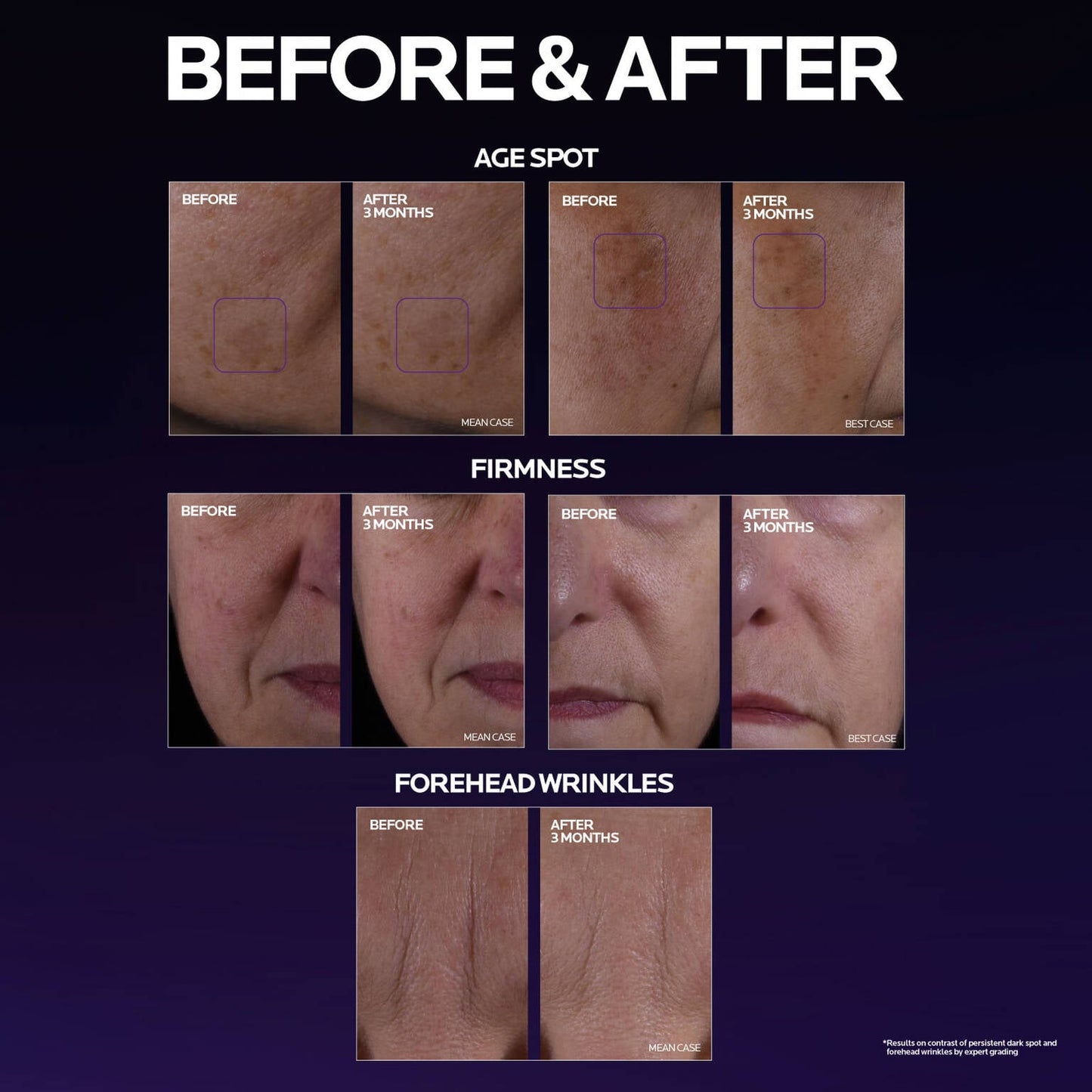 mela-b3-double-dose-discoloration-treatment-with-melasyltm-y2 MelaB3_DD_BTF_BeforeAfter_1500x1500_5.jpg