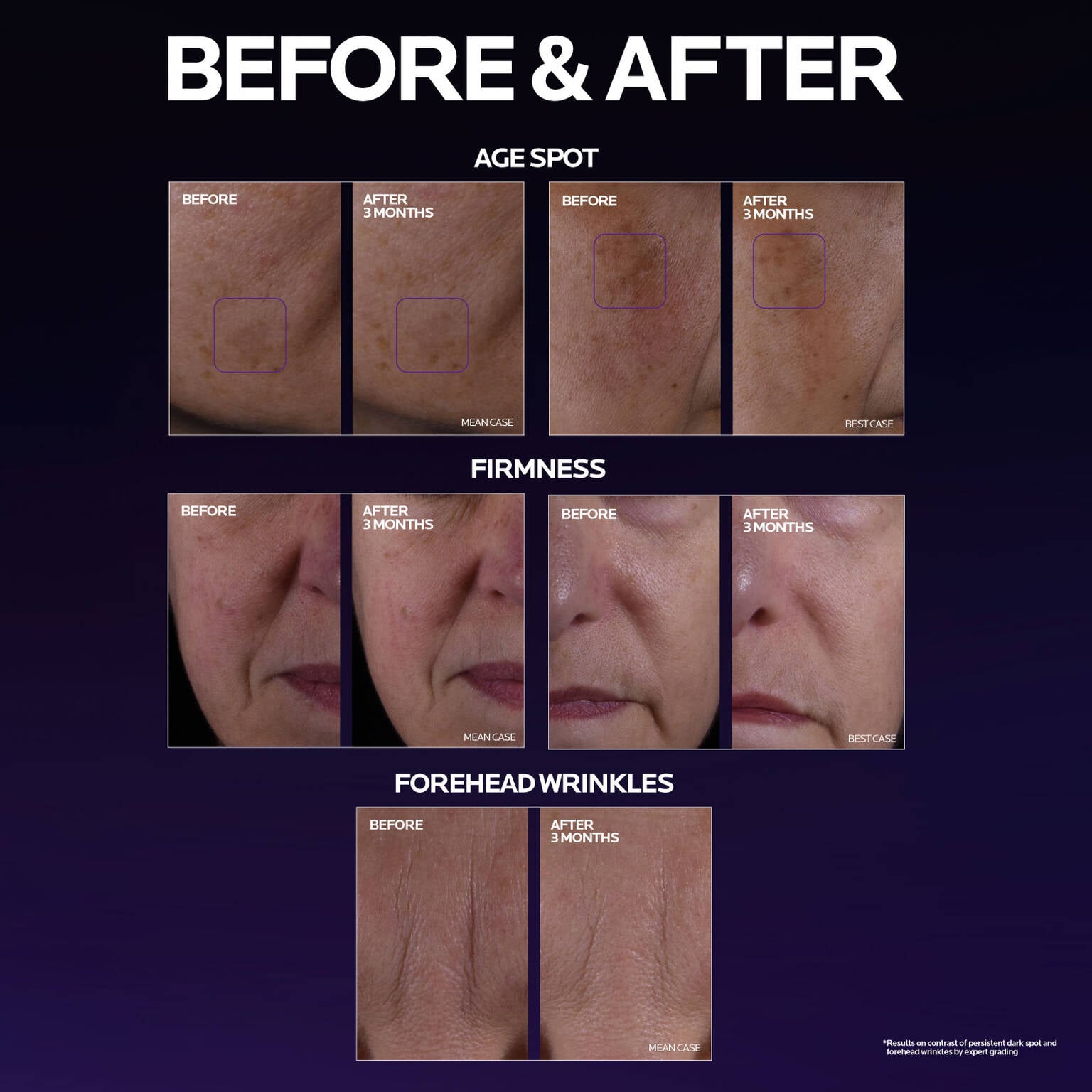 mela-b3-double-dose-discoloration-treatment-with-melasyltm-y2 MelaB3_DD_BTF_BeforeAfter_1500x1500_5.jpg